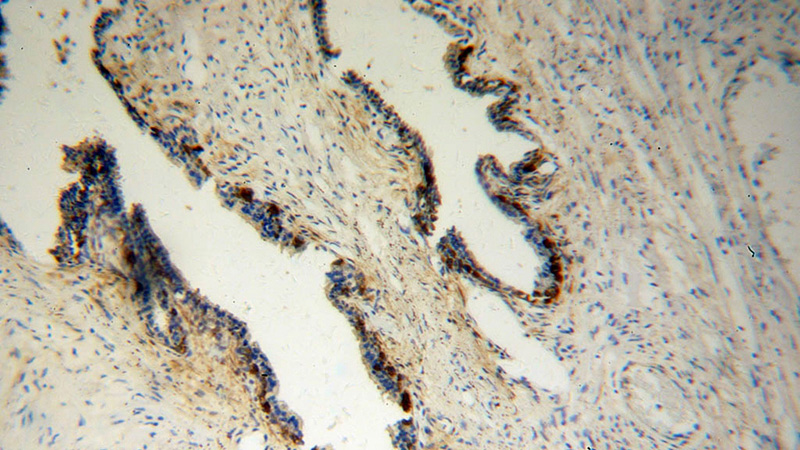 Immunohistochemical of paraffin-embedded human gliomas using Catalog No:112886(CRYM antibody) at dilution of 1:50 (under 10x lens)