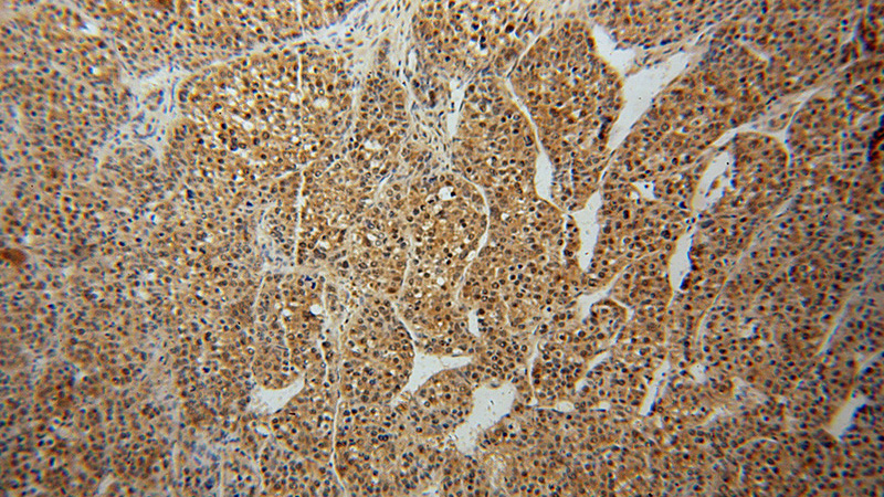 Immunohistochemical of paraffin-embedded human liver cancer using Catalog No:114377(PSMA7 antibody) at dilution of 1:50 (under 10x lens)