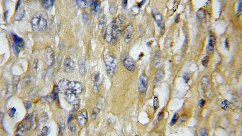 Immunohistochemical of paraffin-embedded human gliomas using Catalog No:109501(COX7C antibody) at dilution of 1:100 (under 10x lens)