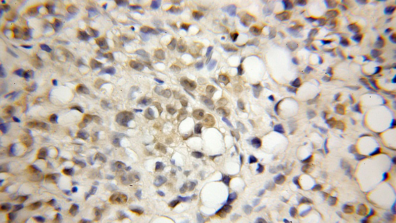 Immunohistochemical of paraffin-embedded human prostate cancer using Catalog No:114858(RTF1 antibody) at dilution of 1:50 (under 10x lens)