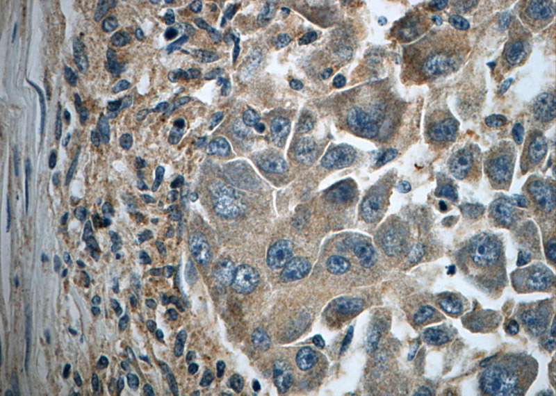 Immunohistochemistry of paraffin-embedded human liver cancer slide using Catalog No:111617(IFIT1 Antibody) at dilution of 1:50
