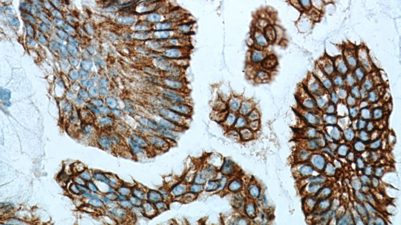 Immunohistochemical of paraffin-embedded human ovary tumor using Catalog No:109811(KRT7-Specific antibody) at dilution of 1:50 (under 40x lens). Heat mediated antigen retrieved with Citric acid buffer, pH6.0