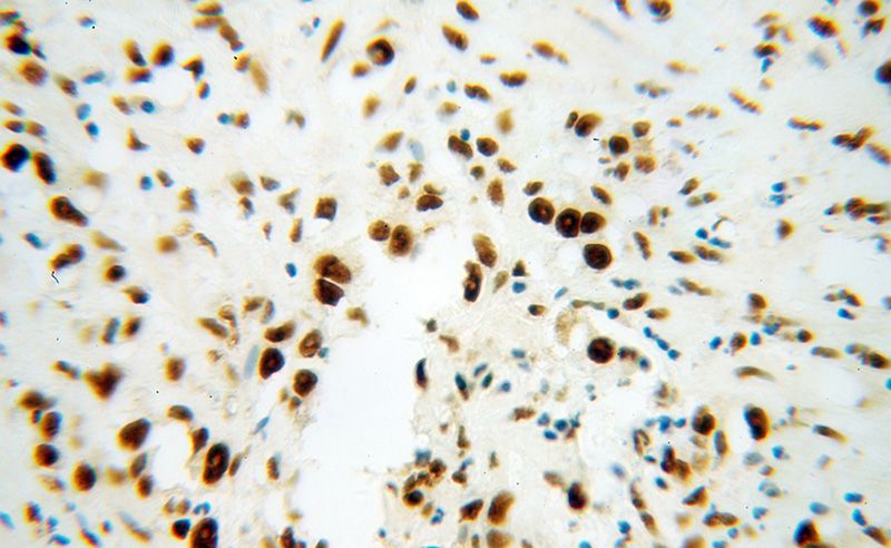 Immunohistochemical of paraffin-embedded human gliomas using Catalog No:115138(SF3B3 antibody) at dilution of 1:100 (under 40x lens)