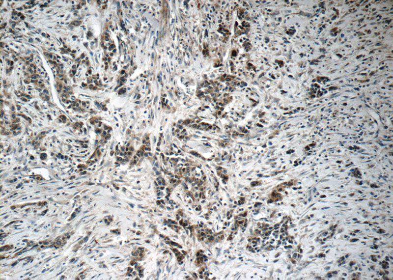 Immunohistochemistry of paraffin-embedded human stomach cancer tissue slide using Catalog No:113708(PGA5 Antibody) at dilution of 1:50 (under 10x lens)