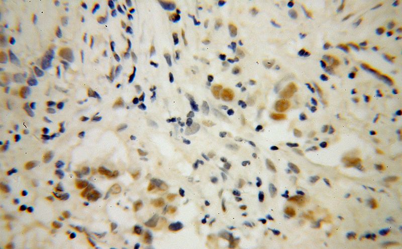 Immunohistochemical of paraffin-embedded human prostate cancer using Catalog No:109873(DAZAP1 antibody) at dilution of 1:100 (under 40x lens)