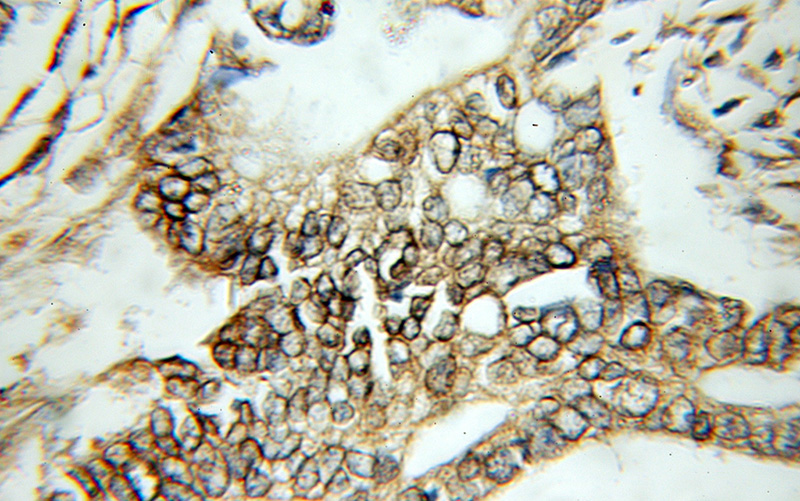 Immunohistochemical of paraffin-embedded human pancreas cancer using Catalog No:115117(SEPT2 antibody) at dilution of 1:50 (under 10x lens)