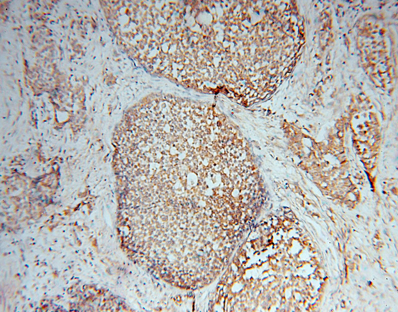 Immunohistochemical of paraffin-embedded human breast cancer using Catalog No:112833(MRPL49 antibody) at dilution of 1:50 (under 10x lens)