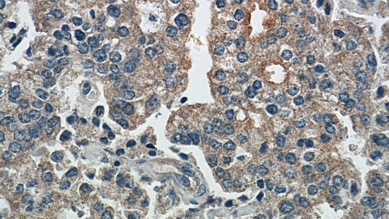 Immunohistochemistry of paraffin-embedded human prostate cancer tissue slide using Catalog No:109729(CTPS2 Antibody) at dilution of 1:50 (under 40x lens)