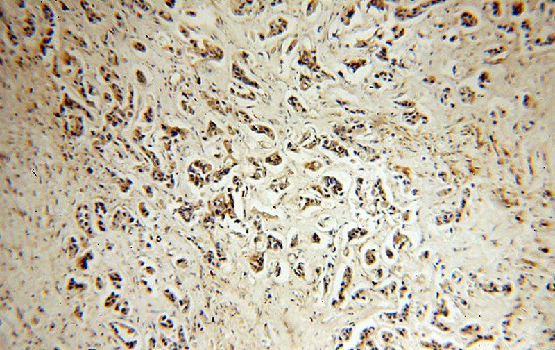 Immunohistochemical of paraffin-embedded human breast cancer using Catalog No:112960(NAT1 antibody) at dilution of 1:50 (under 10x lens)