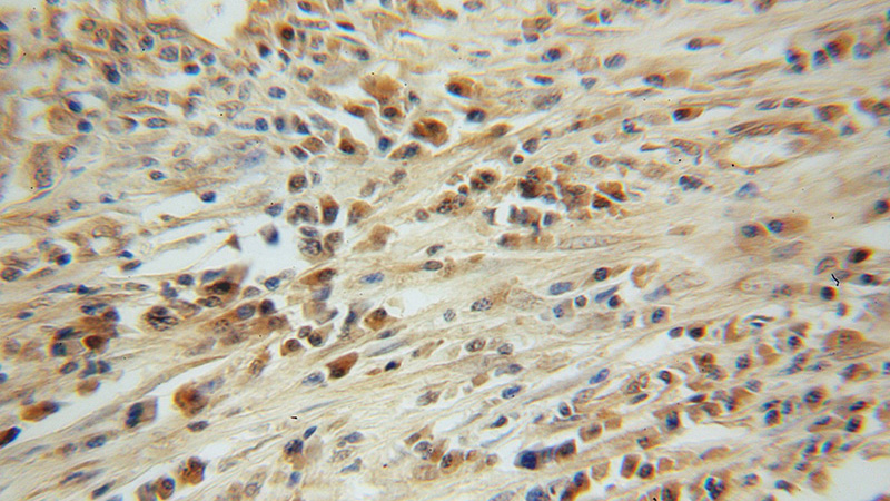 Immunohistochemical of paraffin-embedded human lung cancer using Catalog No:109351(CLEC1A antibody) at dilution of 1:100 (under 40x lens)