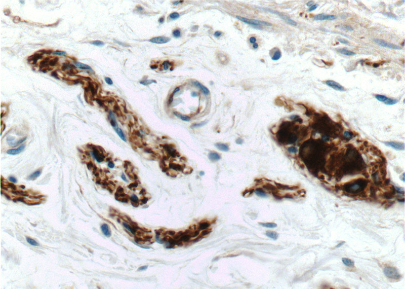 Immunohistochemistry of paraffin-embedded human colon tissue slide using Catalog No:113716(Peripherin Antibody) at dilution of 1:50 (under 40x lens)
