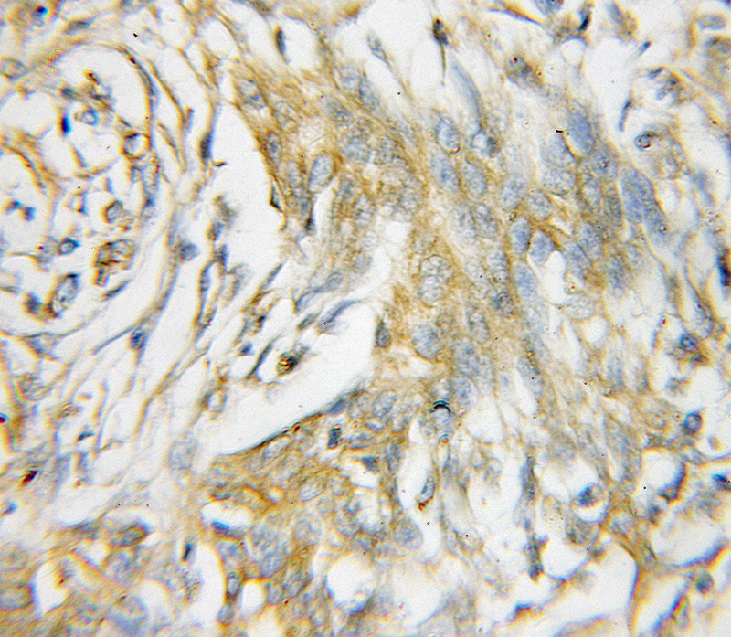Immunohistochemical of paraffin-embedded human pancreas cancer using Catalog No:109478(CTTN antibody) at dilution of 1:100 (under 10x lens)