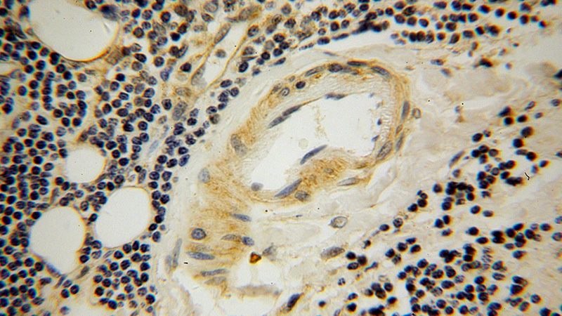 Immunohistochemical of paraffin-embedded human lymphoma using Catalog No:115811(STXBP3 antibody) at dilution of 1:100 (under 40x lens)