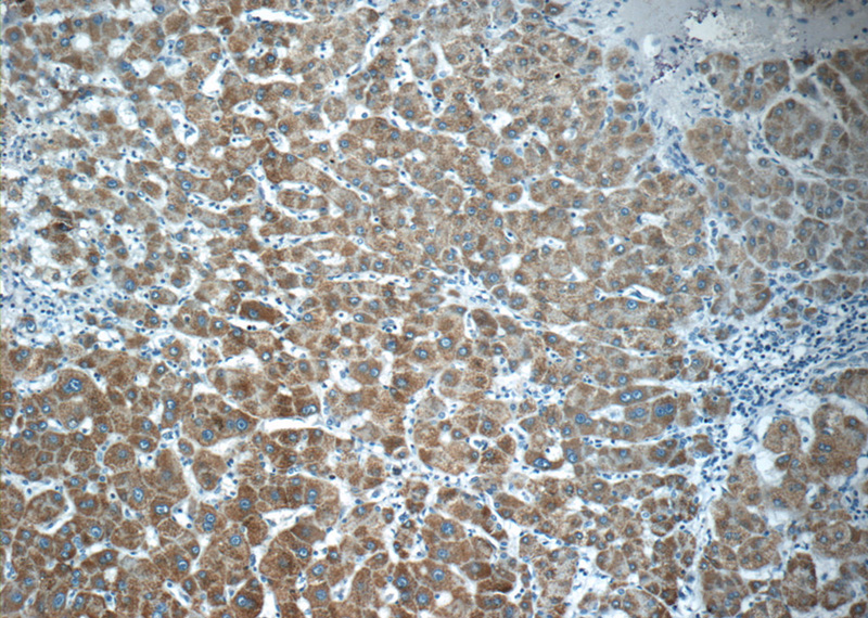 Immunohistochemistry of paraffin-embedded human hepatocirrhosis tissue slide using Catalog No:117201(BMP9 Antibody) at dilution of 1:50 (under 10x lens)