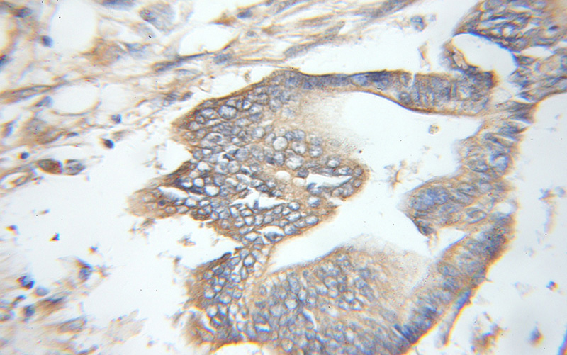 Immunohistochemical of paraffin-embedded human pancreas cancer using Catalog No:114395(PSMD12 antibody) at dilution of 1:50 (under 10x lens)