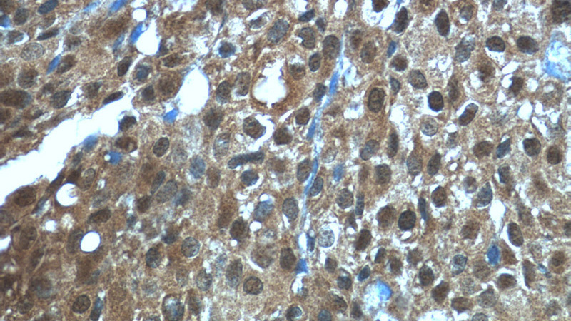 Immunohistochemistry of paraffin-embedded human breast cancer tissue slide using Catalog No:115887(TBX18 Antibody) at dilution of 1:50 (under 40x lens)