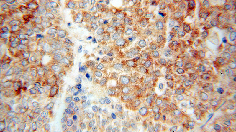 Immunohistochemical of paraffin-embedded human liver cancer using Catalog No:113993(POFUT1 antibody) at dilution of 1:50 (under 40x lens)