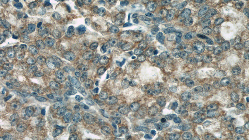 Immunohistochemical of paraffin-embedded human prostate cancer using Catalog No:117311(COXIV antibody) at dilution of 1:100 (under 40x lens)