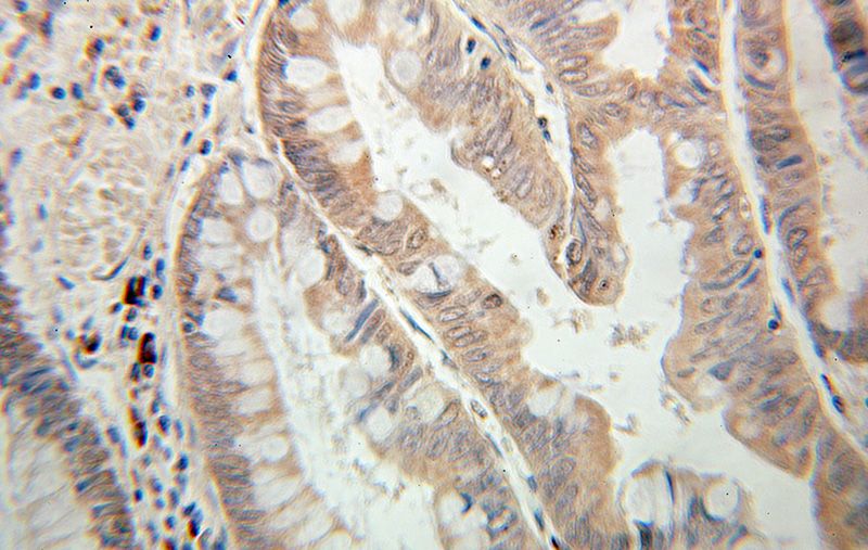 Immunohistochemical of paraffin-embedded human colon cancer using Catalog No:114320(PTPN23 antibody) at dilution of 1:100 (under 10x lens)