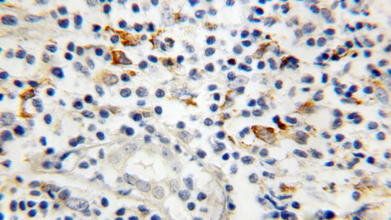 Immunohistochemical of paraffin-embedded human breast cancer using Catalog No:112709(MMP9 antibody) at dilution of 1:50 (under 40x lens)