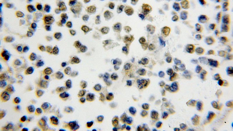 Immunohistochemical of paraffin-embedded human lymphoma using Catalog No:115395(SMNDC1 antibody) at dilution of 1:50 (under 10x lens)