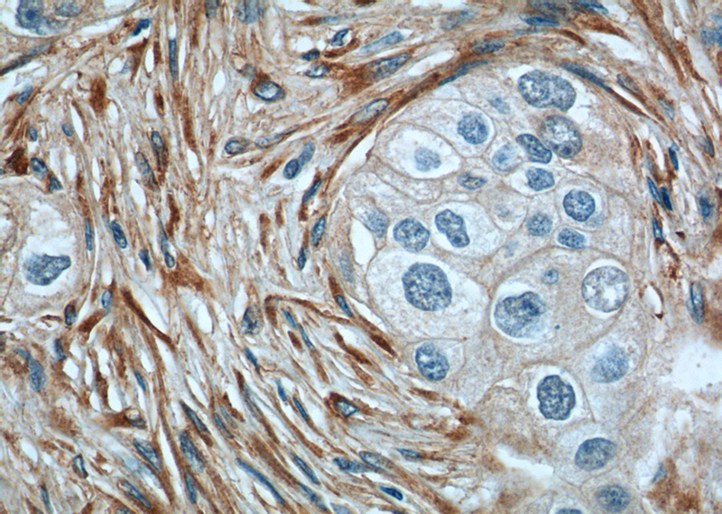 Immunohistochemistry of paraffin-embedded human breast cancer tissue slide using Catalog No:109375(COL1A2 Antibody) at dilution of 1:200 (under 40x lens). heat mediated antigen retrieved with Tris-EDTA buffer(pH9).