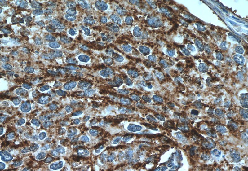 Immunohistochemistry of paraffin-embedded human cervical cancer tissue slide using Catalog No:113999(POLD3 Antibody) at dilution of 1:50 (under 40x lens)