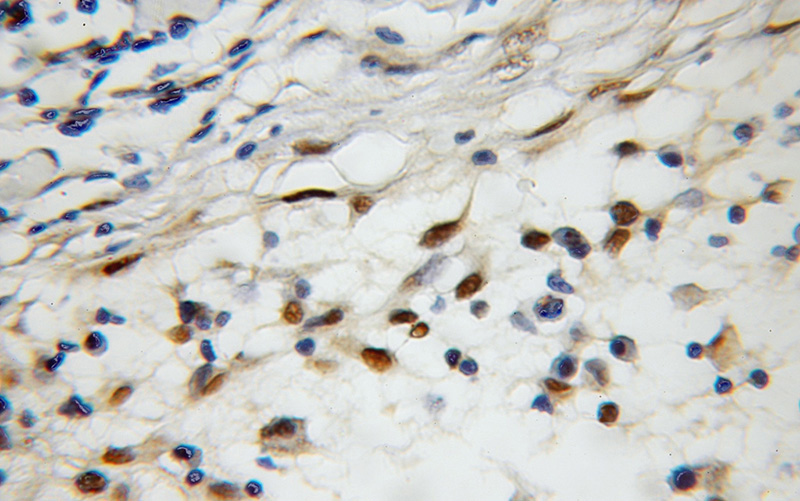 Immunohistochemical of paraffin-embedded human lymphoma using Catalog No:107827(AGFG2 antibody) at dilution of 1:50 (under 10x lens)
