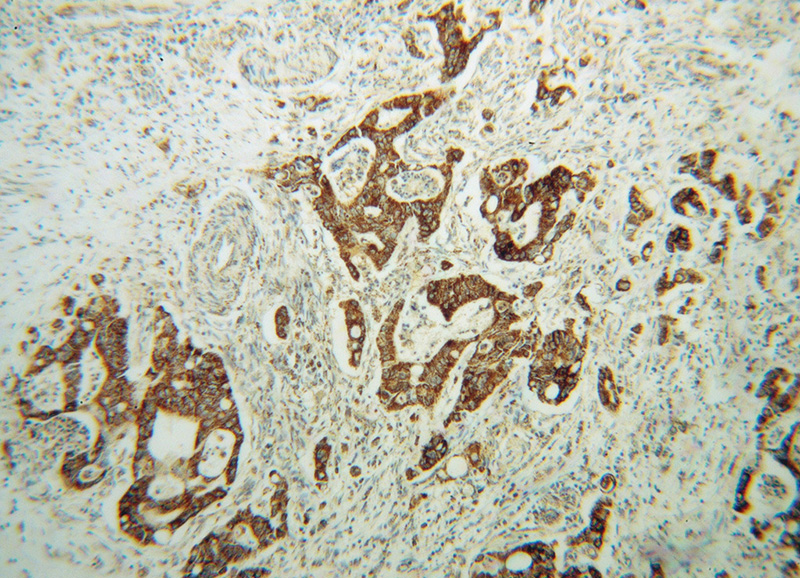 Immunohistochemical of paraffin-embedded human colon cancer using Catalog No:107997(AMN1 antibody) at dilution of 1:100 (under 10x lens)