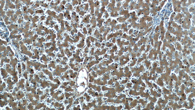 Immunohistochemical of paraffin-embedded human liver using Catalog No:107580(Alpha-1-Antitrypsin antibody) at dilution of 1:50 (under 10x lens)