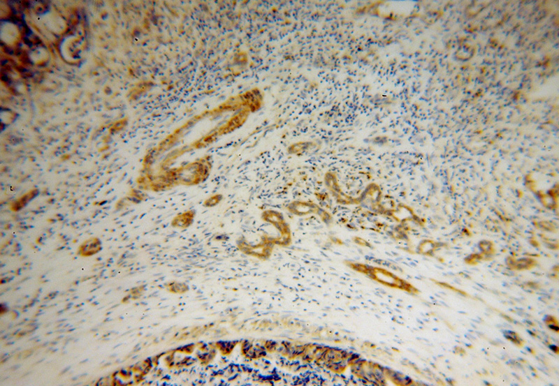 Immunohistochemical of paraffin-embedded human liver cancer using Catalog No:107968(ALDH3A2 antibody) at dilution of 1:100 (under 10x lens)