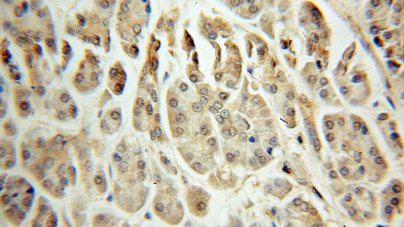 Immunohistochemical of paraffin-embedded human pancreas cancer using Catalog No:112512(MEST antibody) at dilution of 1:100 (under 10x lens)