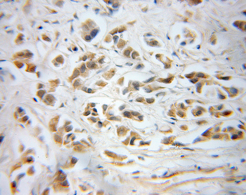 Immunohistochemical of paraffin-embedded human prostate cancer using Catalog No:114143(PPP1CB antibody) at dilution of 1:50 (under 40x lens)