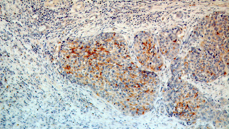 Immunohistochemical of paraffin-embedded human cervical cancer using Catalog No:112822(MRPL3 antibody) at dilution of 1:100 (under 10x lens)
