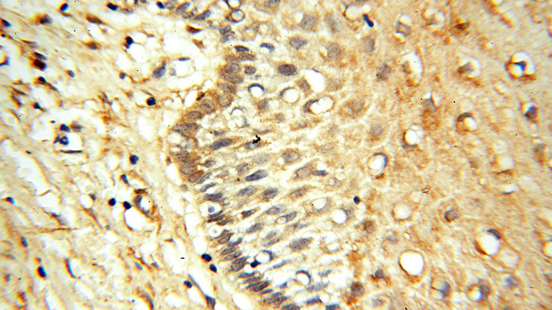 Immunohistochemical of paraffin-embedded human cervix using Catalog No:111187(GSTM4 antibody) at dilution of 1:100 (under 40x lens)