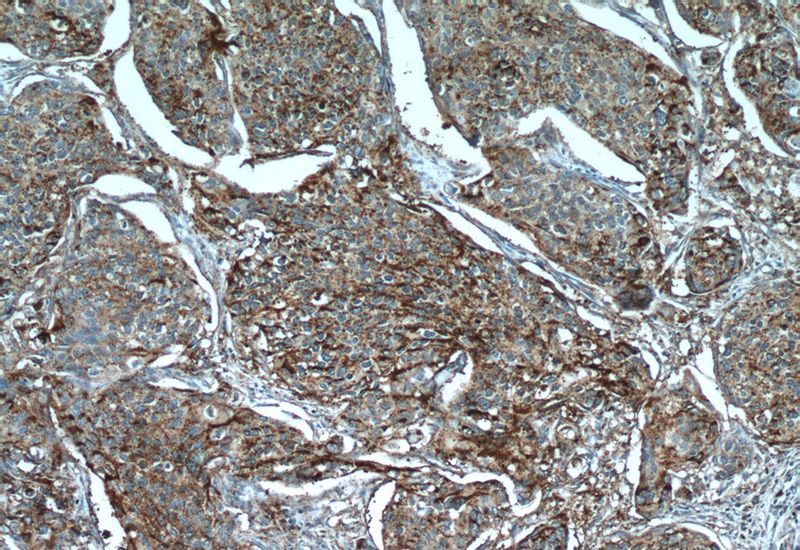 Immunohistochemistry of paraffin-embedded human cervical cancer tissue slide using Catalog No:113999(POLD3 Antibody) at dilution of 1:50 (under 10x lens)