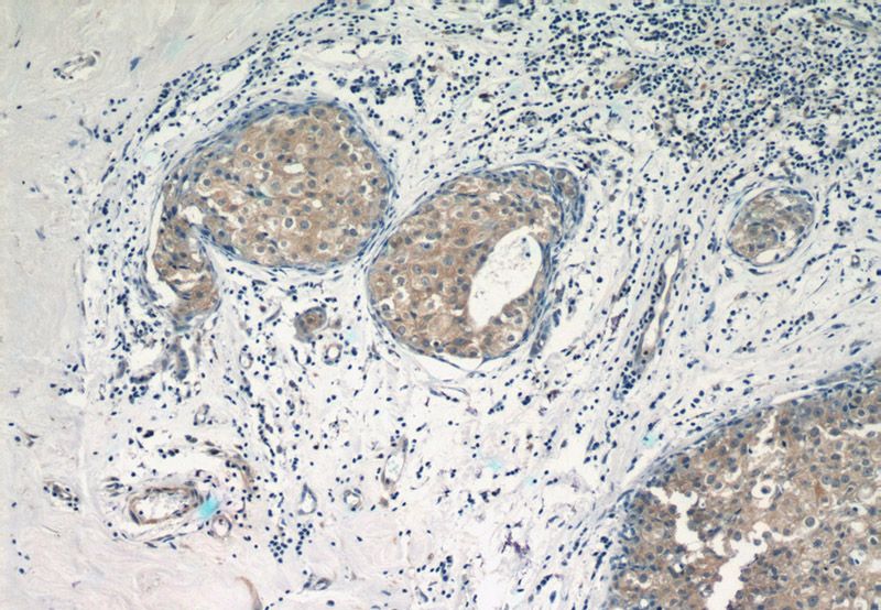 Immunohistochemistry of paraffin-embedded human breast cancer tissue slide using Catalog No:116231(TRAF3IP1 Antibody) at dilution of 1:50 (under 10x lens)