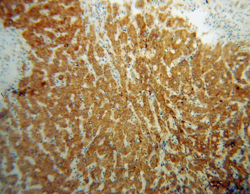 Immunohistochemical of paraffin-embedded human liver cancer using Catalog No:107723(ACADVL antibody) at dilution of 1:50 (under 10x lens)