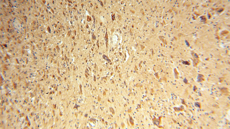 Immunohistochemical of paraffin-embedded human gliomas using Catalog No:112335(LRRC4C antibody) at dilution of 1:50 (under 10x lens)