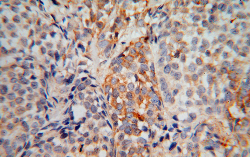 Immunohistochemical of paraffin-embedded human breast cancer using Catalog No:110412(EXOSC5 antibody) at dilution of 1:50 (under 40x lens)