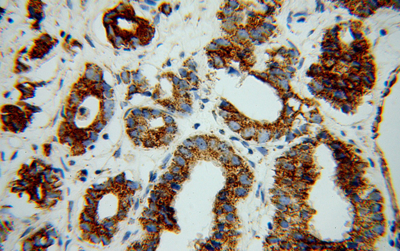 Immunohistochemical of paraffin-embedded human gliomas using Catalog No:111042(GLUD1 antibody) at dilution of 1:100 (under 40x lens)
