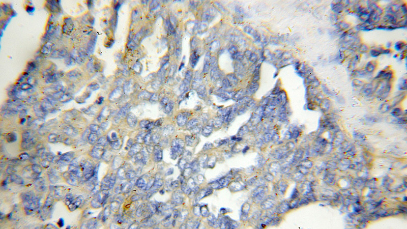 Immunohistochemical of paraffin-embedded human ovary tumor using Catalog No:112056(FERMT2 antibody) at dilution of 1:50 (under 10x lens)