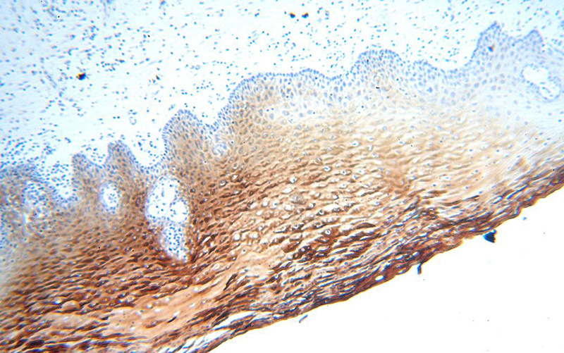 Immunohistochemical of paraffin-embedded human cervix using Catalog No:112134(KRT6B antibody) at dilution of 1:100 (under 10x lens)