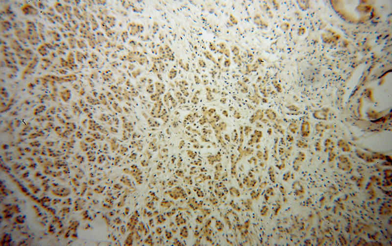 Immunohistochemical of paraffin-embedded human pancreas cancer using Catalog No:113492(SERPINE1 antibody) at dilution of 1:50 (under 10x lens)