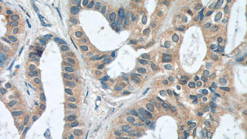 Immunohistochemistry of paraffin-embedded human breast cancer tissue slide using Catalog No:114327(PTPRE Antibody) at dilution of 1:200 (under 40x lens).