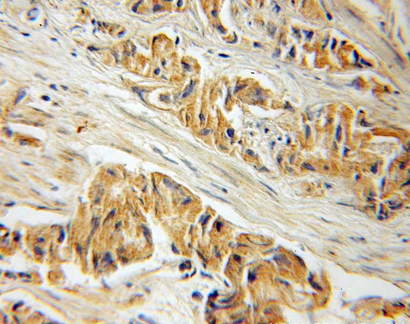 Immunohistochemical of paraffin-embedded human prostate cancer using Catalog No:109547(CREB3L1,OASIS antibody) at dilution of 1:50 (under 25x lens)