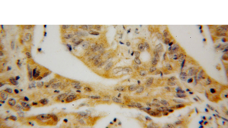 Immunohistochemical of paraffin-embedded human colon cancer using Catalog No:115681(STARD7 antibody) at dilution of 1:100 (under 40x lens)