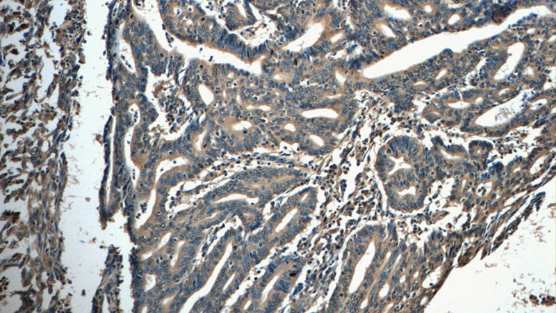 Immunohistochemistry of paraffin-embedded human endometrial cancer tissue slide using Catalog No:111665(IFT20 Antibody) at dilution of 1:50 (under 10x lens)
