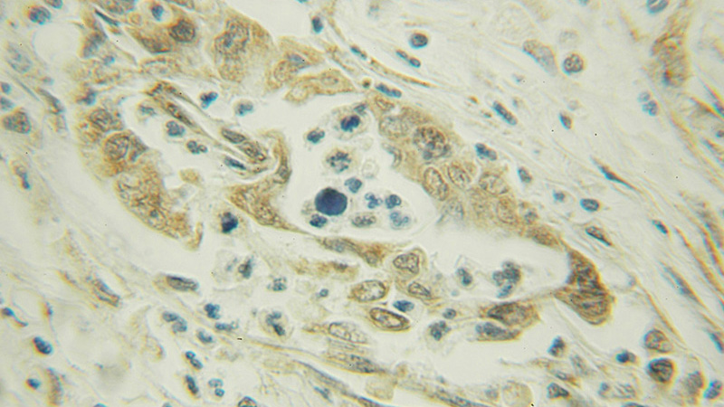 Immunohistochemical of paraffin-embedded human pancreas cancer using Catalog No:107924(AK3 antibody) at dilution of 1:50 (under 10x lens)