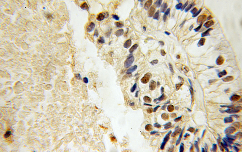 Immunohistochemical of paraffin-embedded human ovary tumor using Catalog No:112374(MAFF antibody) at dilution of 1:100 (under 10x lens)